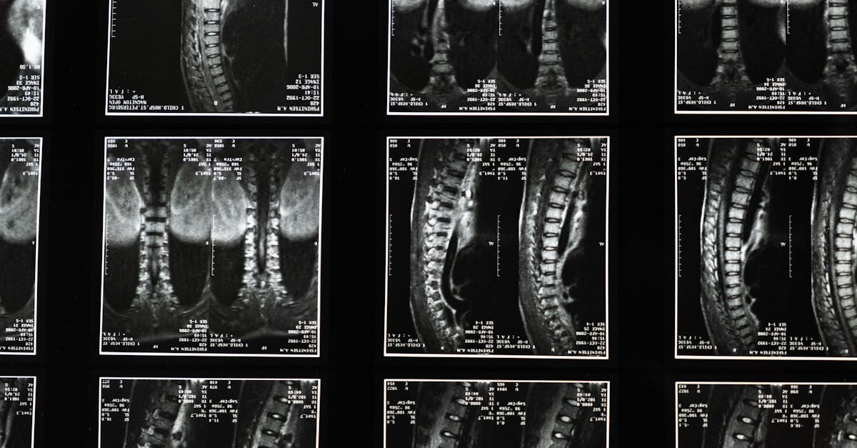 discover essential information about spinal stenosis, its causes, symptoms, and effective treatment options to help manage this condition and improve your quality of life.