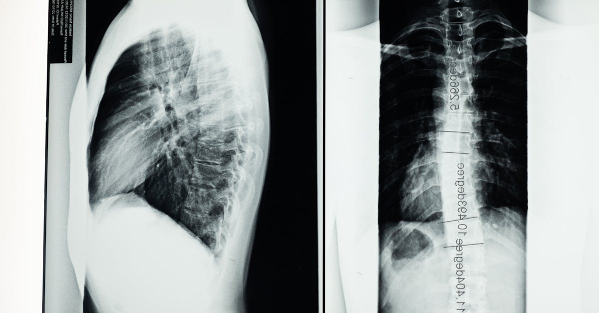 discover effective solutions and insights for thoracic spine pain. learn about causes, symptoms, and treatment options to alleviate discomfort and improve your quality of life.