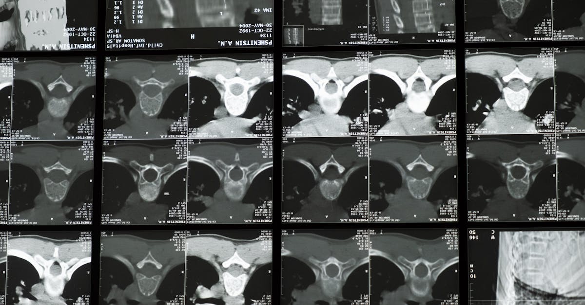 discover comprehensive insights into scoliosis, including its causes, symptoms, diagnosis, and treatment options. empower yourself with knowledge about this spinal condition and explore effective management strategies for a healthier back.