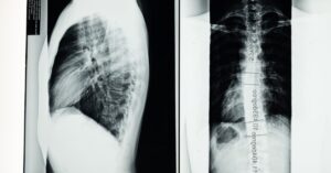 discover comprehensive insights into scoliosis, a condition characterized by an abnormal curvature of the spine. explore its causes, symptoms, diagnosis, and treatment options to help manage and improve quality of life.