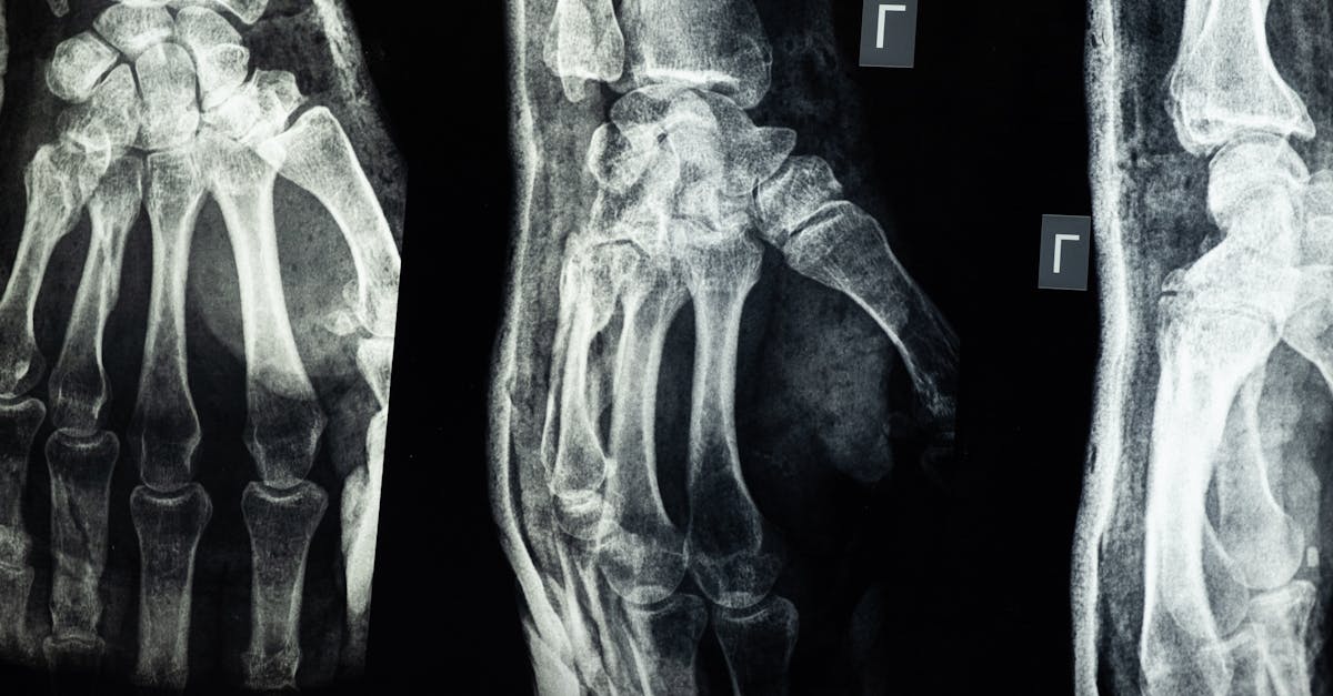 explore the causes, symptoms, and treatment options for brachial plexus injury. this comprehensive guide provides insights into recovery and rehabilitation for those affected by this complex nerve injury.